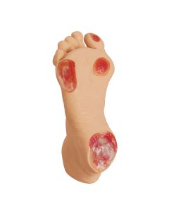Elderly Chronic Pressure Ulcer Foot
